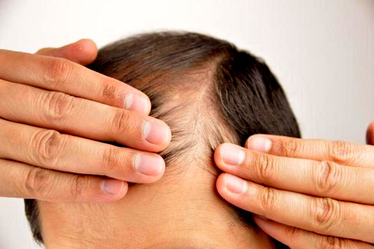 داروهای ریزش موی مناسب کدامند؟ چگونه ریزش مو را درمان می‌کنند؟