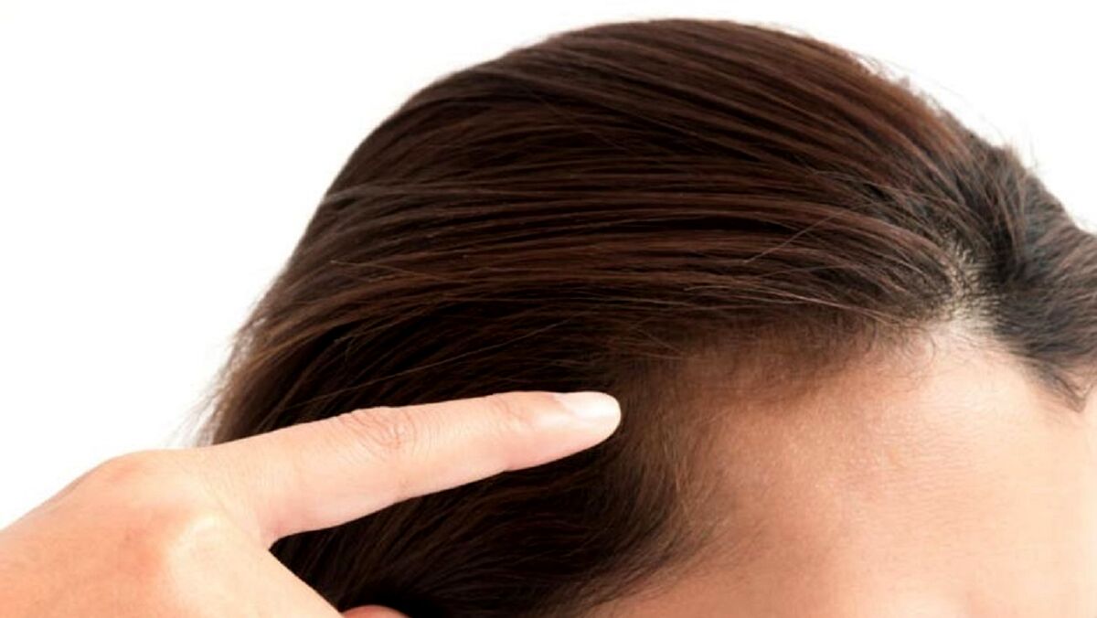 استرس زیاد باعث ریزش مو می ‌شود + جزئیات