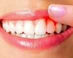 رژیم غذایی چگونه بر سلامت لثه تاثیرگذار است؟