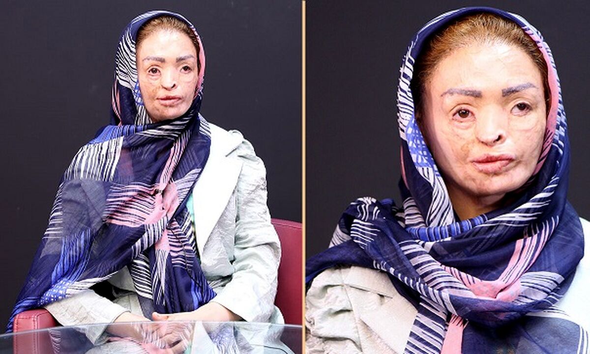 چهره هولناک دختر تبریزی همه را ترساند
