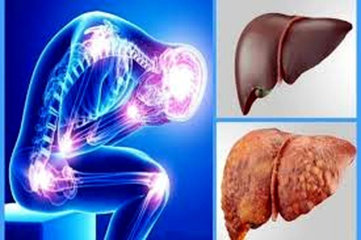 چرا مبتلایان به کبد چرب جان خود را از دست می دهند؟