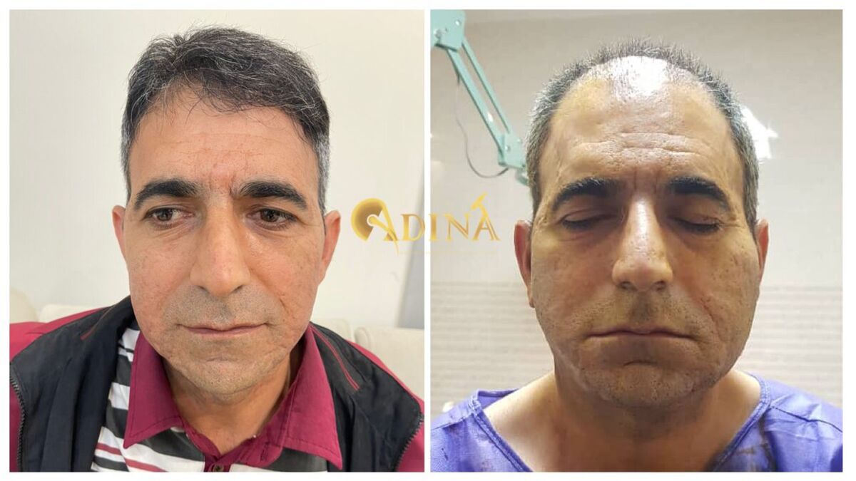 بهترین روش کاشت مو با تراکم بالا برای افرادی با بانک موی ضعیف