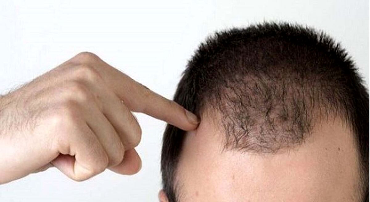 تشخیص ریزش مو