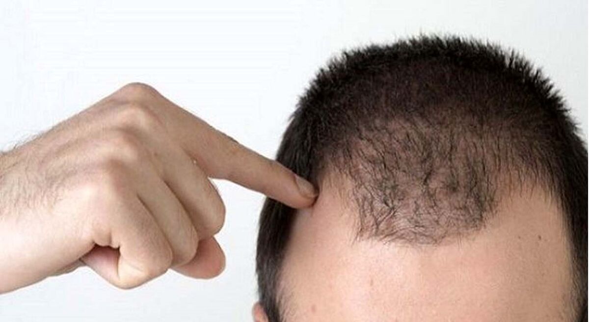 تشخیص ریزش مو