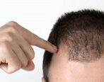 تشخیص ریزش مو