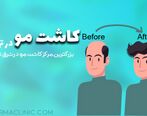 بهترین کلینیک کاشت مو و ابرو در تهران