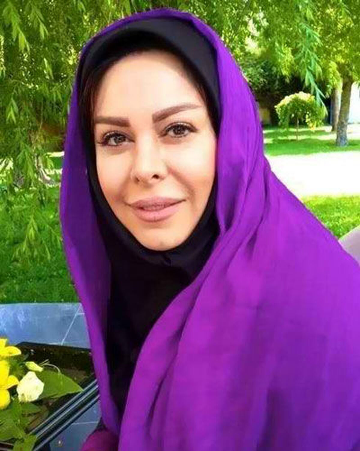 صورت پف کرده فلور نظری از تزریق ژل زیبایی!| عکس عجیب فلور نظری
