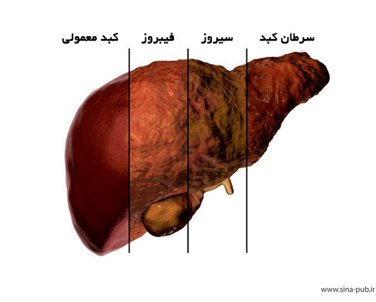 علائم بیماری کبد چرب را بشناسید