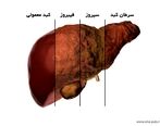 علائم بیماری کبد چرب را بشناسید