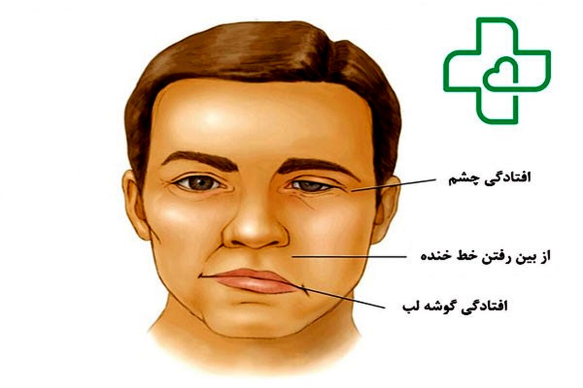 فلج کلی یا تتراپلژی چیست؟ علائم + درمان