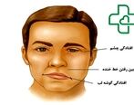 فلج کلی یا تتراپلژی چیست؟ علائم + درمان