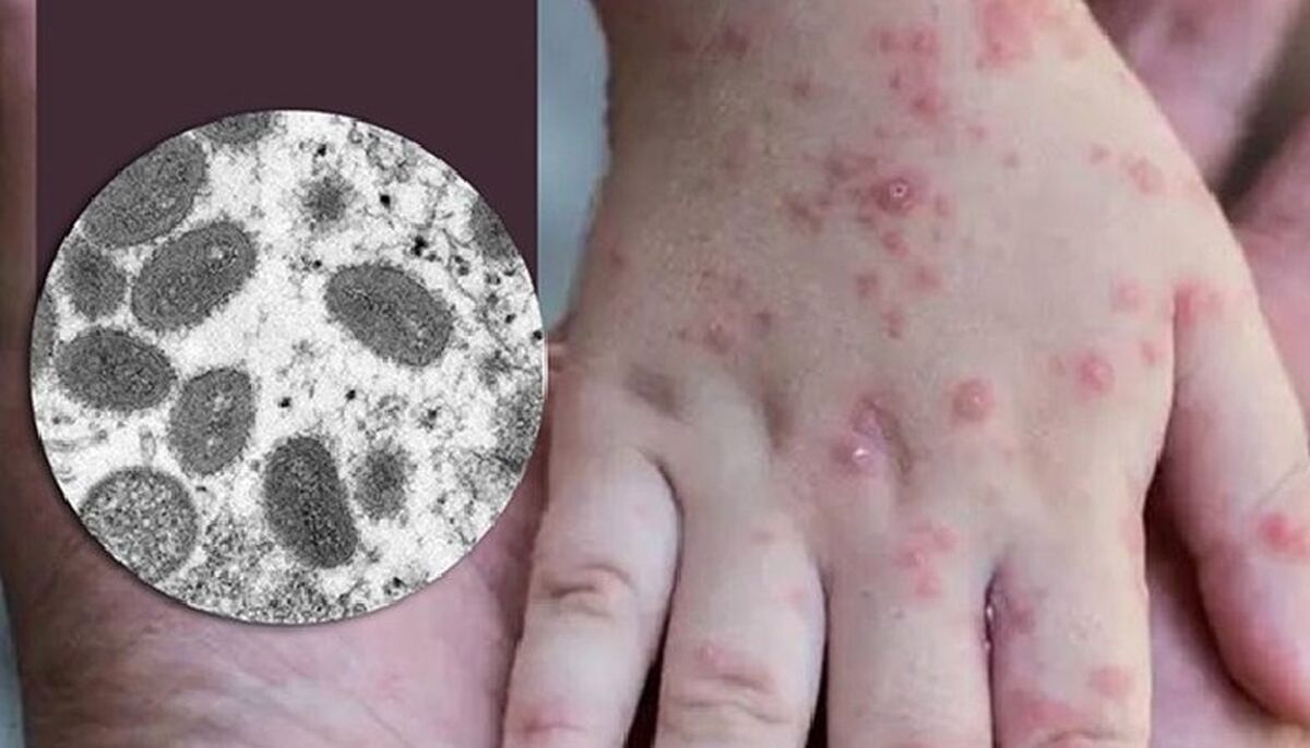 همه گیری آبله میمون هشدار آمیز شد؟ | پیش‌بینی از آینده آبله میمونی