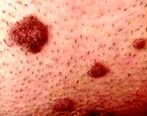زگیل تناسلی چه نشانه هایی دارد و چگونه تشخیص دهیم
