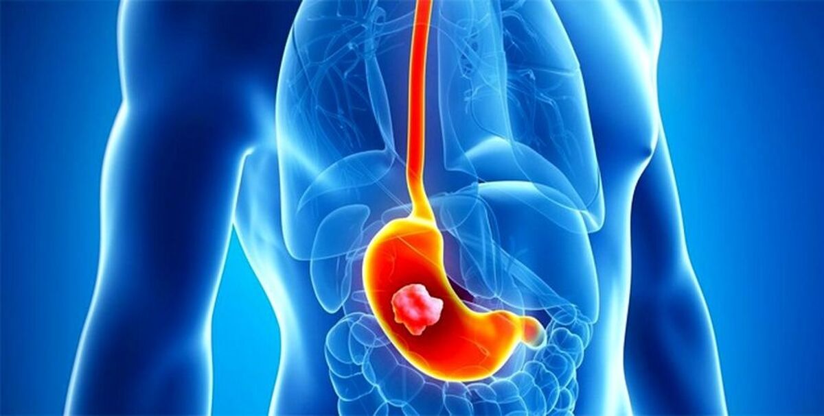 علت اصلی بروز معده درد عصبی چیست؟