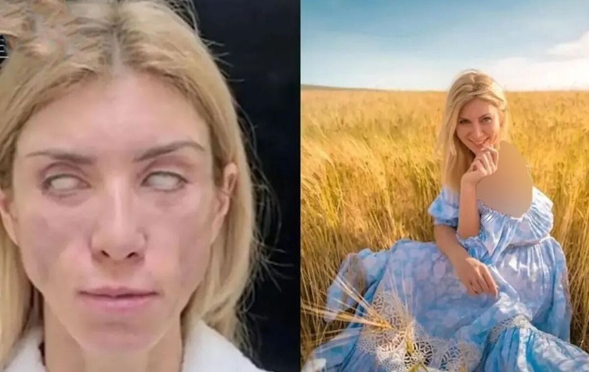 صورت ملکه زیبایی روس نابود ش| عکس های باورنکردنی